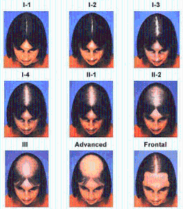 女性脱髮示意圖