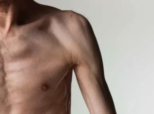 營養不良的症狀和體徵是什麼