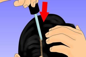 用於治療脱髮的米諾地爾