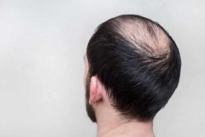 什麼是二氫睾酮脱髮，如何阻止它?