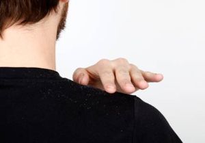 如何治療慢性頭皮屑