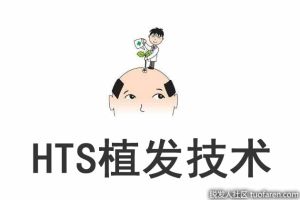什麼是HTS植髮技術？