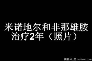 米諾地爾和非那雄胺治療2年（照片）
