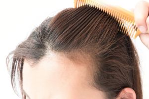 【超全】女性脱髮治療的八種方法