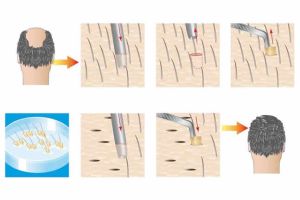 什麼是FUE毛髮移植？