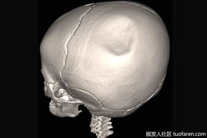 是什麼導致顱骨凹陷？