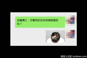 【中德植髮醫院】(圖)髮友問：頭皮有疤痕，能植髮嗎?