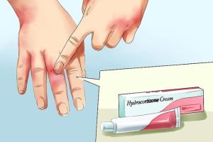 神經性皮炎是什麼?