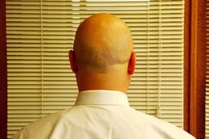 如何在毛囊根部阻止DHT