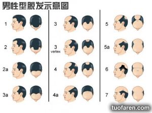 男性型脱髮示意圖