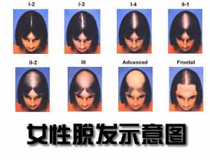 【必讀】90%女性的脱髮原因及治療