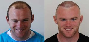 做植髮手術前有些事你要知道