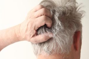 什麼是頭皮濕疹？