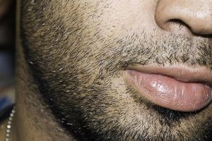 什麼會導致鬍鬚脱落?