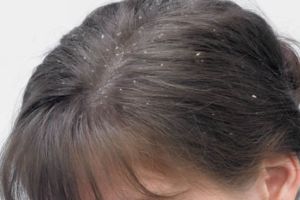 去除頭皮屑的技巧