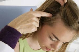 真菌感染會導致脱髮嗎?