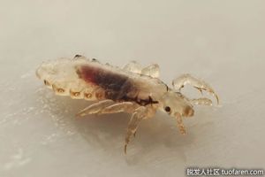 頭皮上有什麼蟲子？