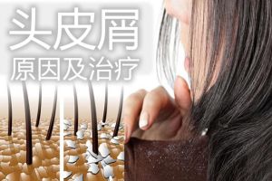 頭皮屑-起因和家庭補救