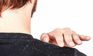 自然療法去除頭皮屑