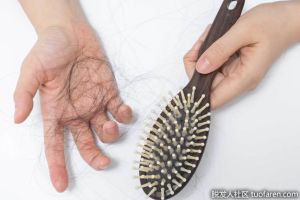 什麼是女性雄激素性脱髮？