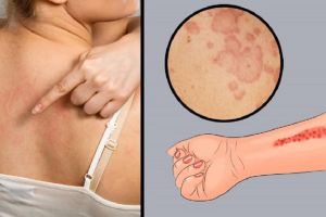 什麼是過敏性蕁麻疹?