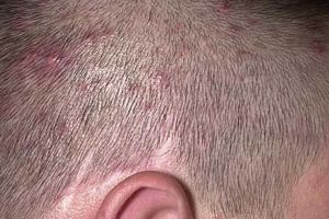 頭皮癬：症狀，原因與治療