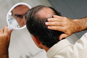 為什麼DHT與脱髮有關