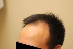 前額脱髮治療的3個選擇