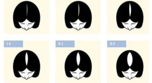 關於女性髮際線的後退