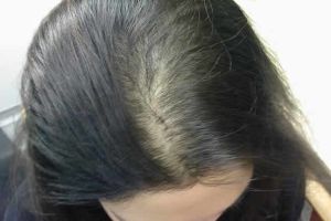 什麼是額部脱髮?它的原因和治療技巧