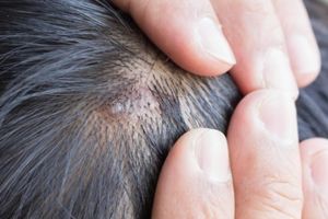 頭皮膿包的常見原因是什麼?