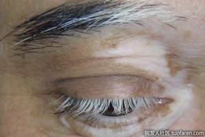 為什麼我的睫毛變白了？