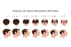 導致脱髮或禿頂的原因