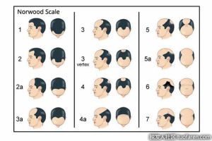 瞭解男性型脱髮