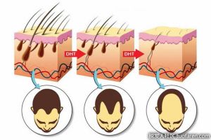 DHT確實會導致脱髮