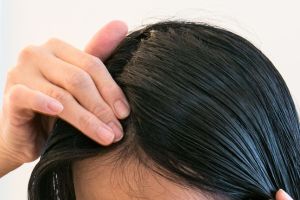 頭皮屑可以用椰子油和茶樹油