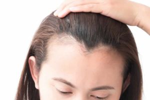 得了頭癬後怎樣再生頭髮?