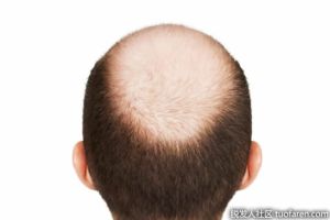 脂溢性脱髮怎麼治療