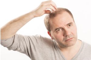 男性脱髮的原因及治療