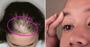 蓖麻油用於頭髮再生長