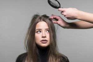 5個去除頭皮屑的小竅門