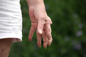 類風濕性關節炎會導致脱髮嗎