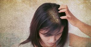 頭皮屑會導致脱髮嗎?你需要知道什麼