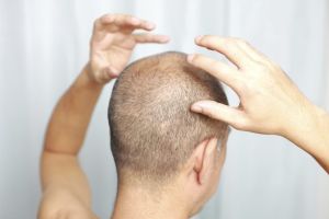 蘆薈能治脱髮嗎