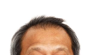 缺鐵會導致頭髮稀疏