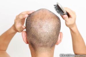 如何確定是脂溢性脱髮