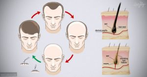 手淫會導致脱髮嗎?科學説什麼