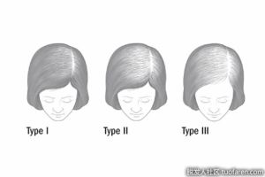 老年女性頭髮稀疏的常見原因是什麼？