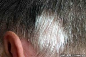 頭髮上天然的白色條紋值得擔心嗎？