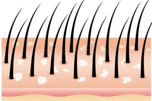 頭皮屑的治療和原因